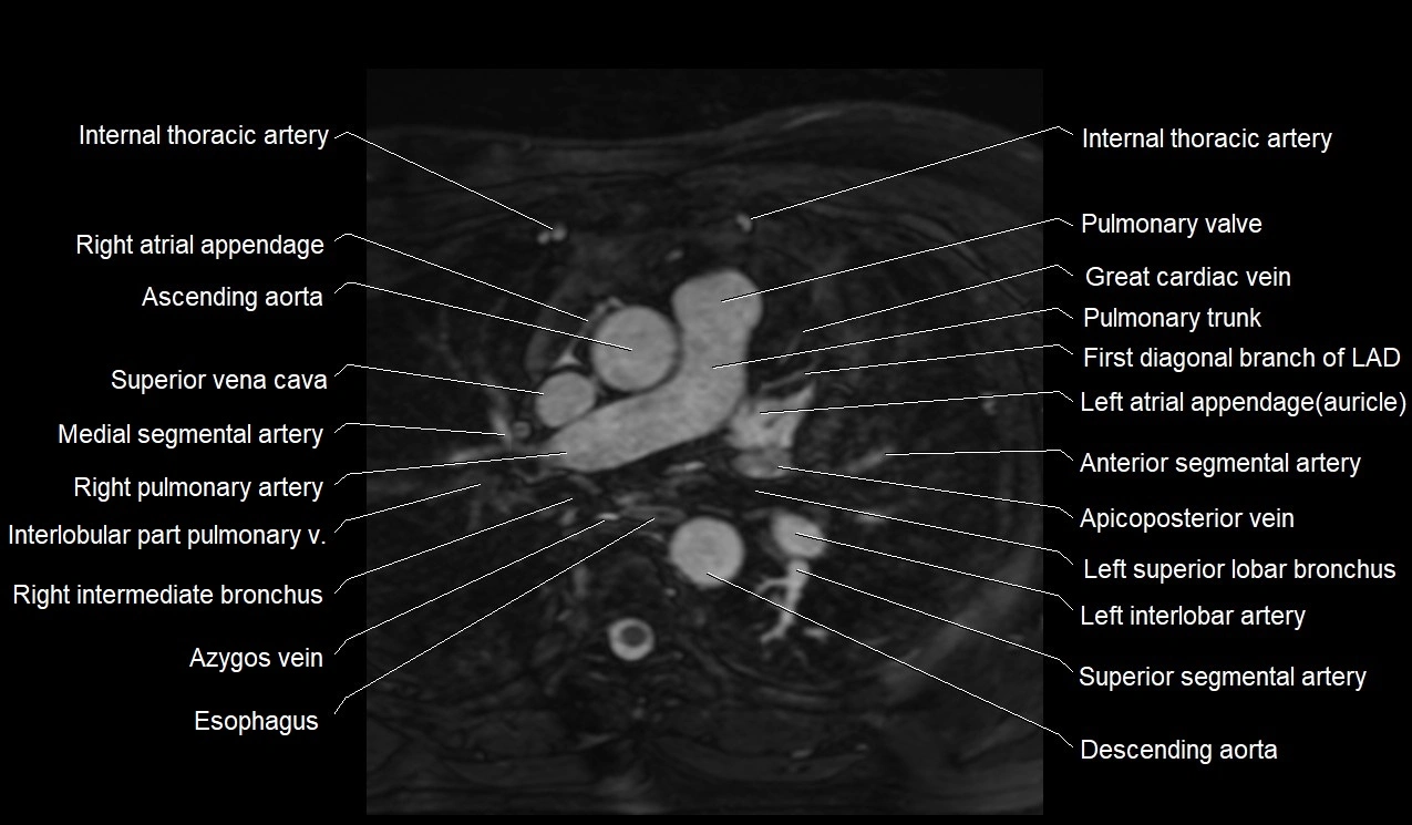 MRI heart coronary arteries and coronary veins anatomy axial image 7.webp